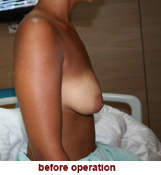 plastic-surgery-breast-lift-augmentation